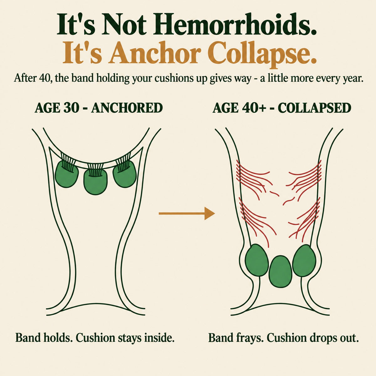 It's not hemorrhoids, it's anchor collapse — age 30 vs age 40+